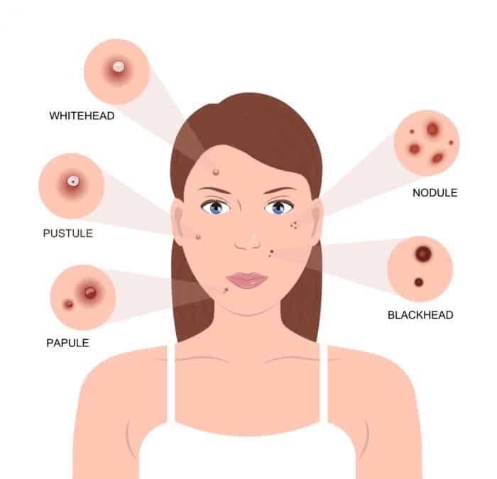 Tipos de acné